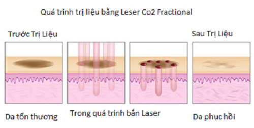 tri-seo-bang-cong-nghe-laser-fractional-co2-1