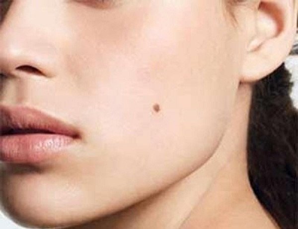 xóa nốt ruồi tại viện thẩm mỹ an an