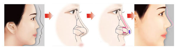 Nâng mũi S-Line không phẫu thuật tiêm chất làm đầy Filler - image_content