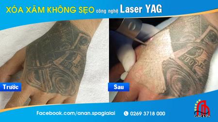 Xóa hình xăm cn YAG Laser tại Gia Lai an toàn, hiệu quả